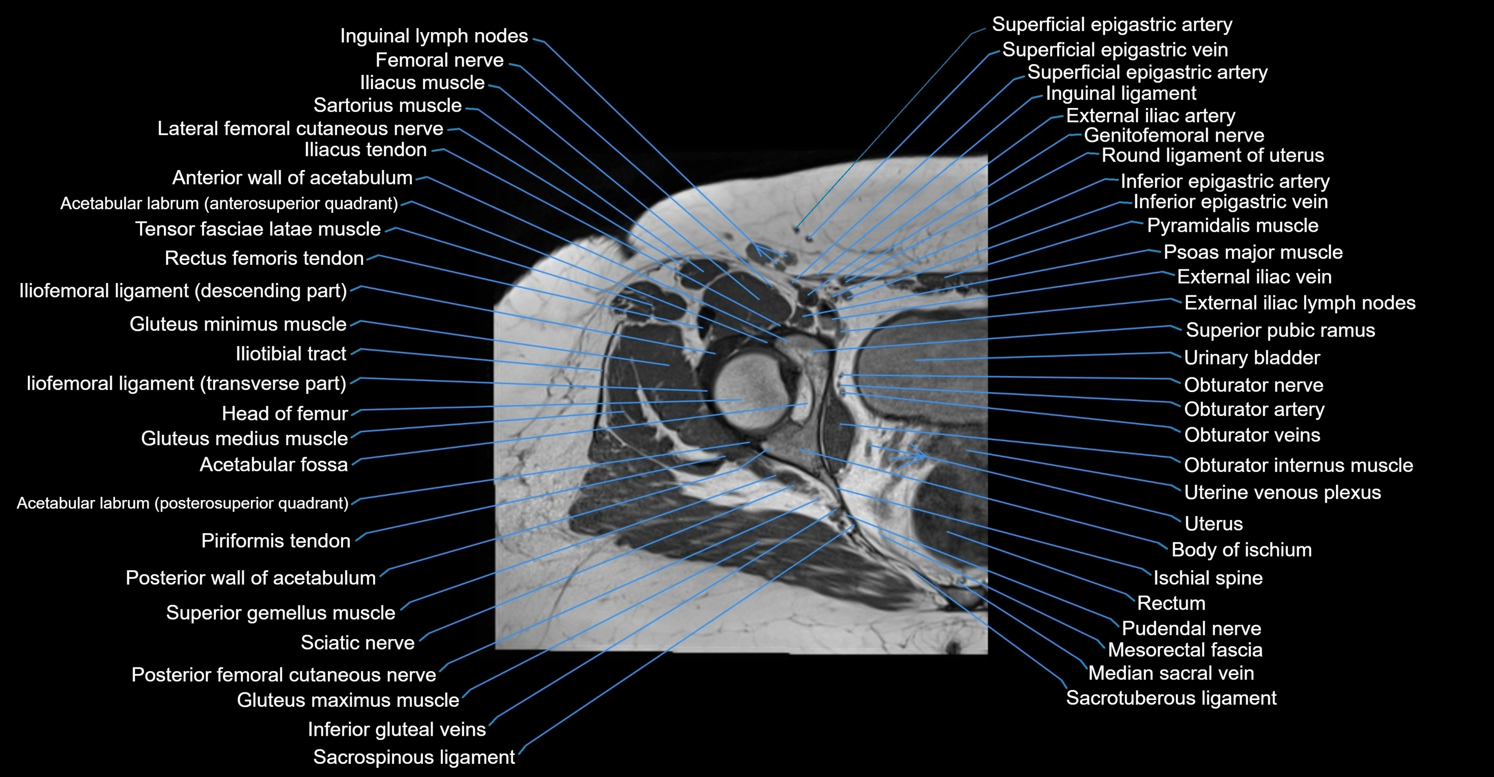 MRI hip axial cross sectional anatomy 3T 3D  radiology  anatomy image-img-00001-00032.webp
